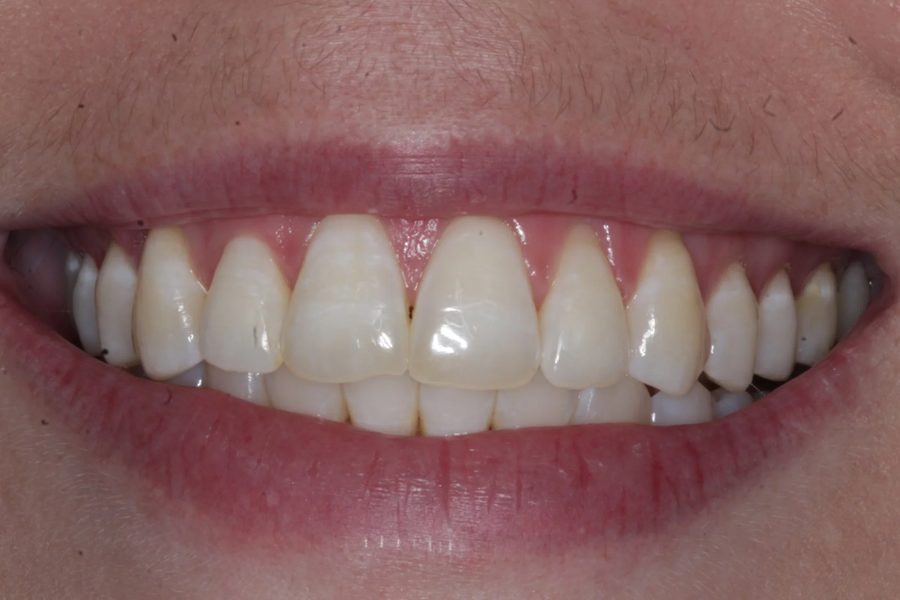 After — Anterior open bite · 12 months